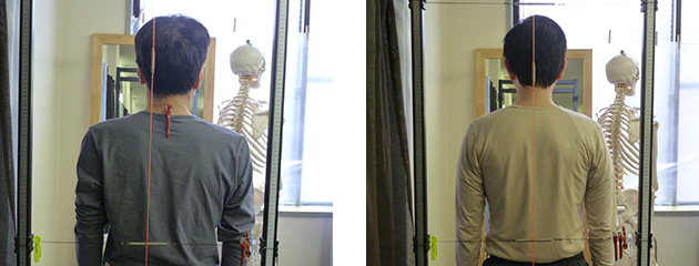 背骨・骨盤の歪み、バランスの異常の検査